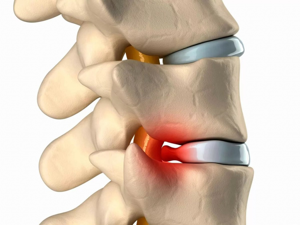 Грижа Шморля: Як вона впливає на здоров'я хребта і які методи лікування доступні